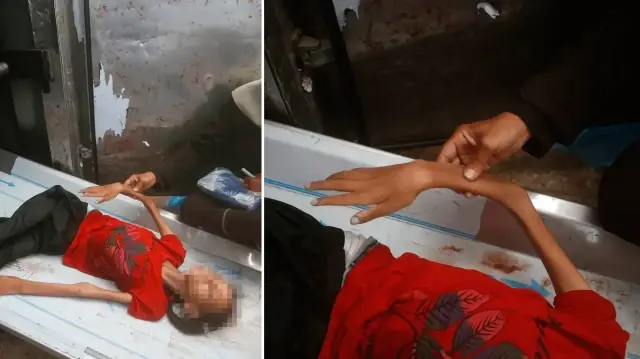 gazzede yetersiz beslenme nedeniyle 17 yasindaki fehime hayatini kaybetti 2vkthzja