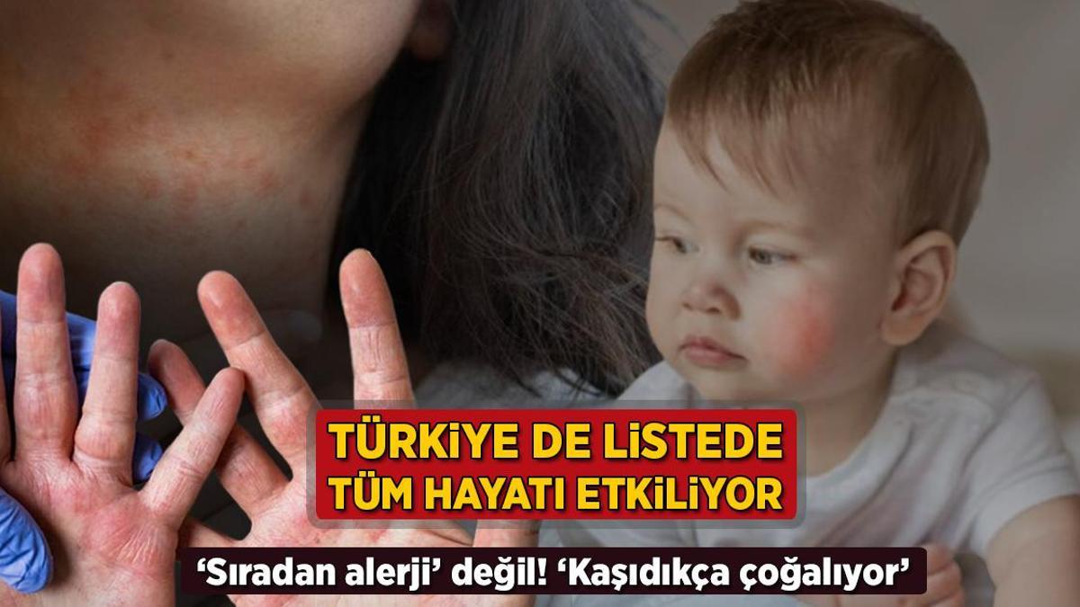 turkiye de listede tum hayati kotu etkiliyor siradan alerji degil kasidikca cogalir fZcRChLw.jpg